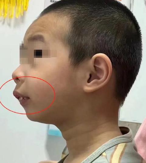 儿童腺样体肥大症状及治疗解析